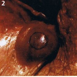 Perianalthrombose